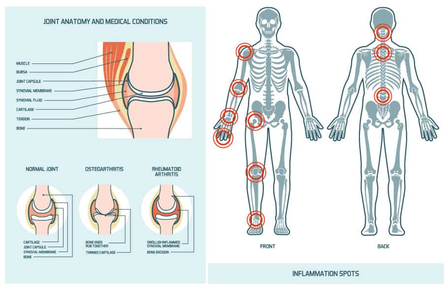 Osteoarthritis Avoiding the Grind SpineOne Denver Back and Neck