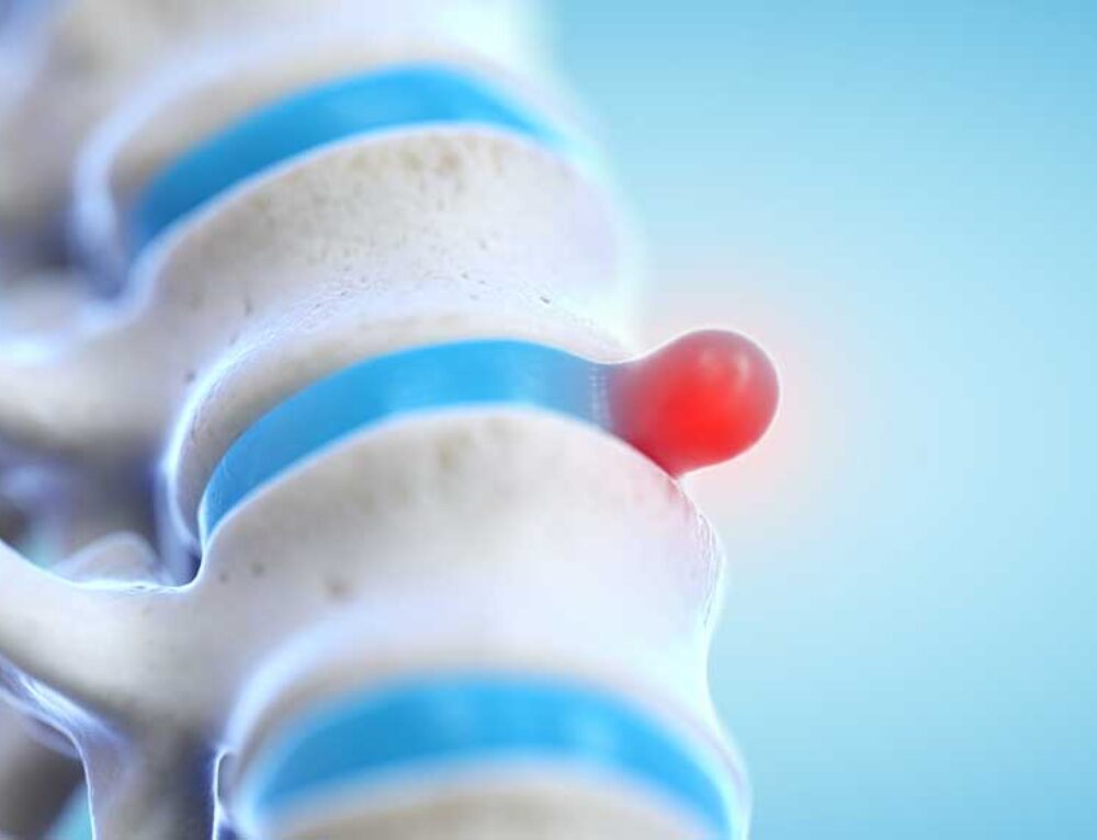 McKenzie Method Exercises and Stretches for Lower Back Pain Relief