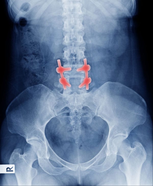 spine-surgery-hardware failed back surgery syndrome causing pain