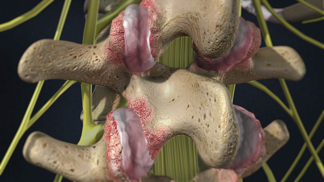 facetsyndrome_1280 Facet Joint Syndrome Pain