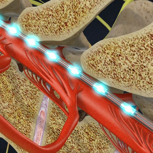 spine-numbness-tingling-paresthesia Spine Stimulator Paresthesia